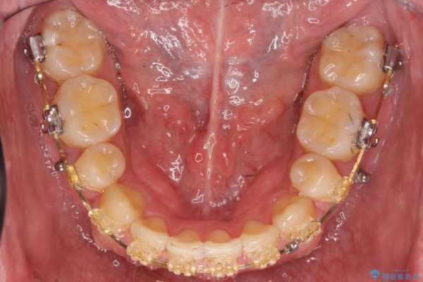 前歯のガタガタと奥歯の噛み合わせの矯正 治療中画像
