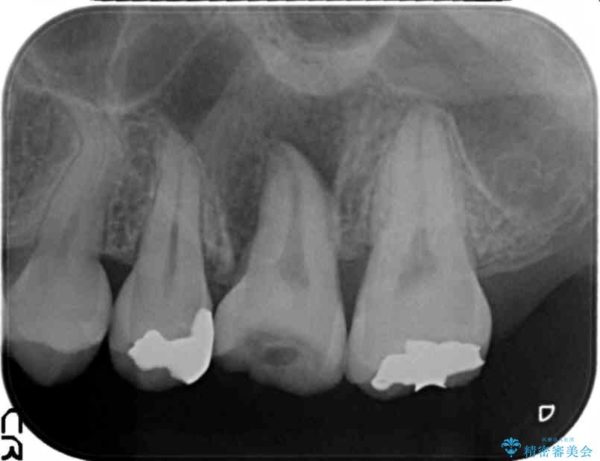 奥歯の親知らず移植 治療中画像