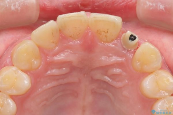 上の前歯のインプラント治療 治療中画像