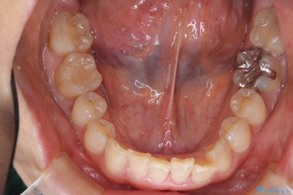 気になる前歯を矯正とセラミックの低予算治療 治療中画像