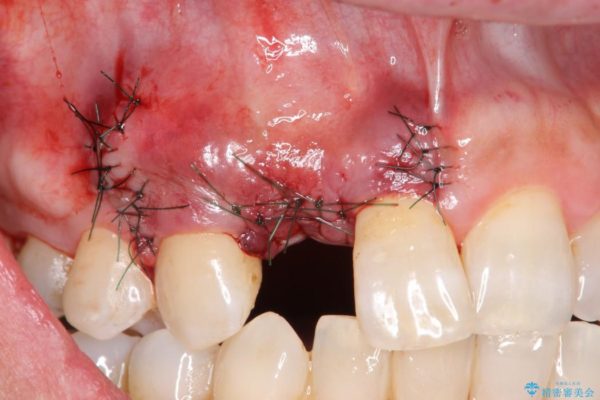 前歯のインプラント治療(インプラント埋入まで) 治療中画像