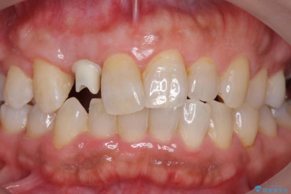 前歯のインプラント治療(セラミック治療編) 治療中画像