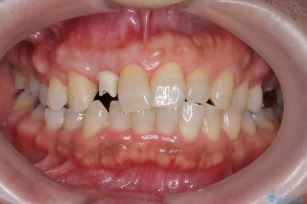 前歯のインプラント治療(セラミック治療編) 治療中画像