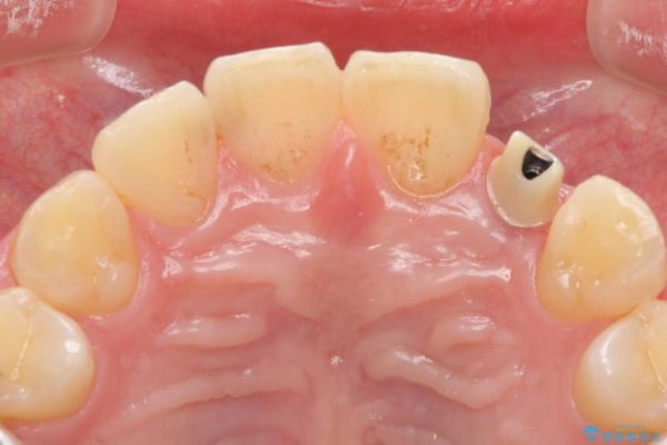 左上前歯のインプラント治療（セラミック治療編） 治療中画像