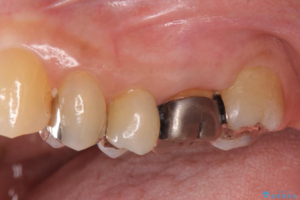 大きな穴があいた奥歯のブリッジ治療 ビフォー