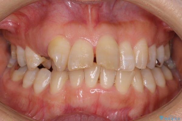 気になる前歯を矯正とセラミックの低予算治療 治療前画像