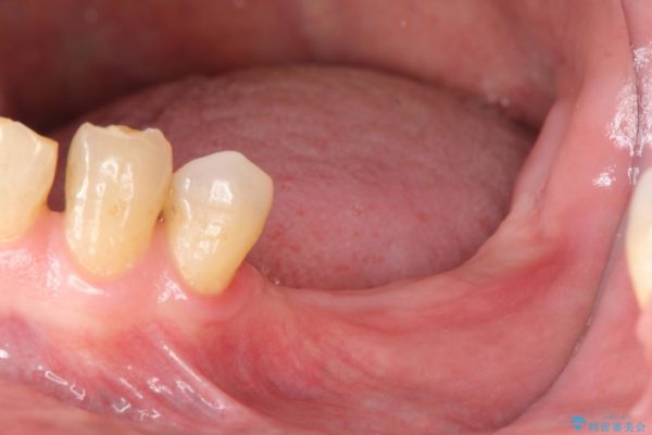 奥歯で噛みたいインプラント治療 治療前画像