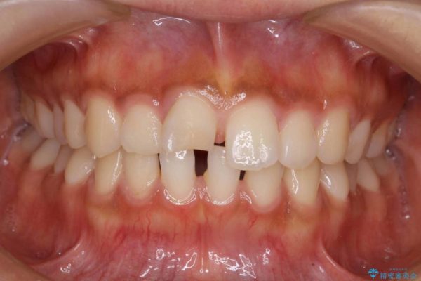 20代女性 すきっ歯の矯正歯科治療 治療前画像