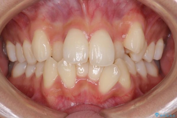 根の短い歯を抜歯 がたがたの歯並び矯正 ビフォー