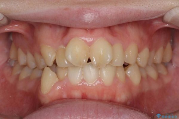 前歯のねじれと出っ歯の矯正 治療前画像