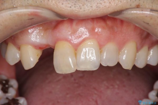 前歯のインプラント治療(インプラント埋入まで) ビフォー