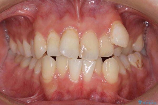 反対咬合（奥歯）のワイヤー矯正治療 治療前画像