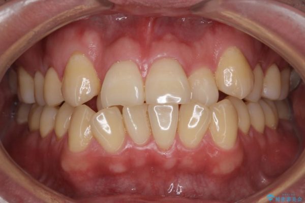 前歯のガタガタと奥歯の噛み合わせの矯正 ビフォー