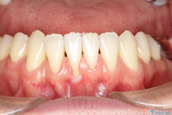 【歯肉退縮】歯ぐきの再生治療（歯茎の移植） 治療前画像