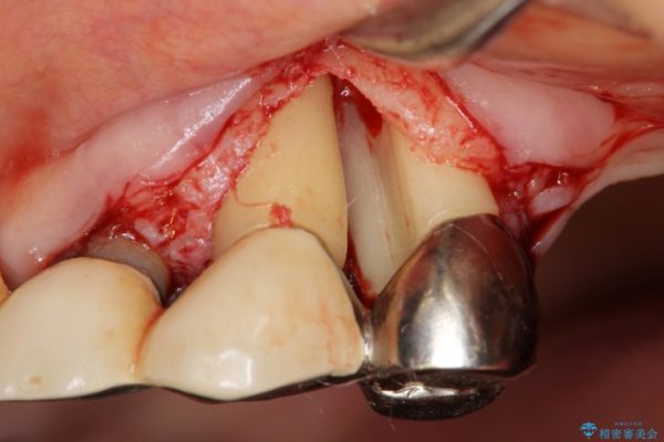 重度歯周病治療(歯槽骨の再生治療) ビフォー