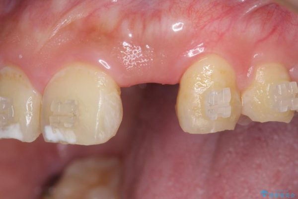 左上前歯のインプラント治療（インプラント埋入まで） 治療前画像