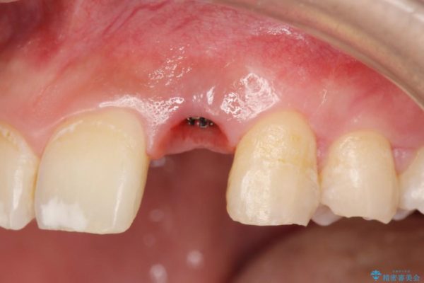 左上前歯のインプラント治療（セラミック治療編） 治療前画像