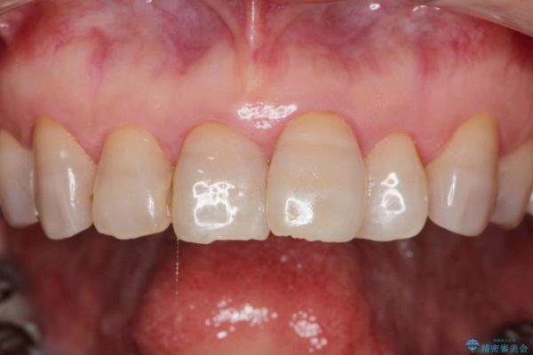 テトラサイクリンによる変色歯のセラミック治療 治療前画像