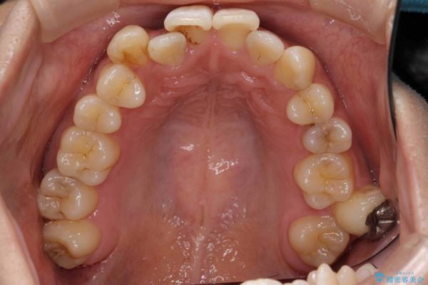 天然歯を活かす、スレ違い咬合矯正 治療前画像