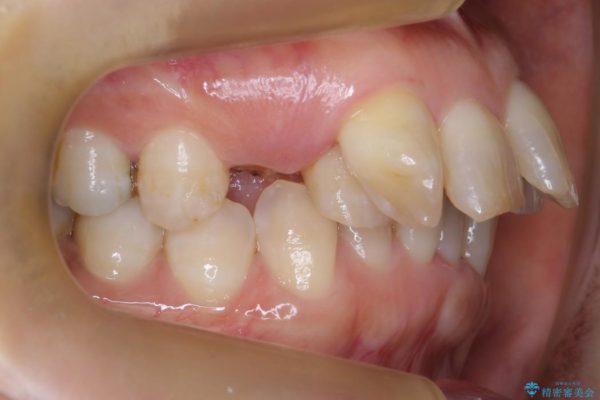 気になる前歯を矯正とセラミックの低予算治療 治療前画像