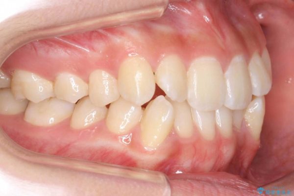 前歯の叢生のインビザライン矯正 治療前画像