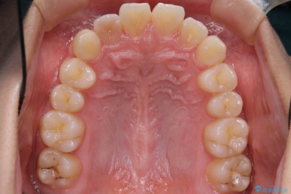 インビザラインで再矯正治療と右上前歯のセラミック治療 治療前画像