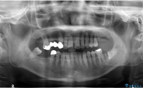 インプラントを用いた重度歯周病治療 治療前画像
