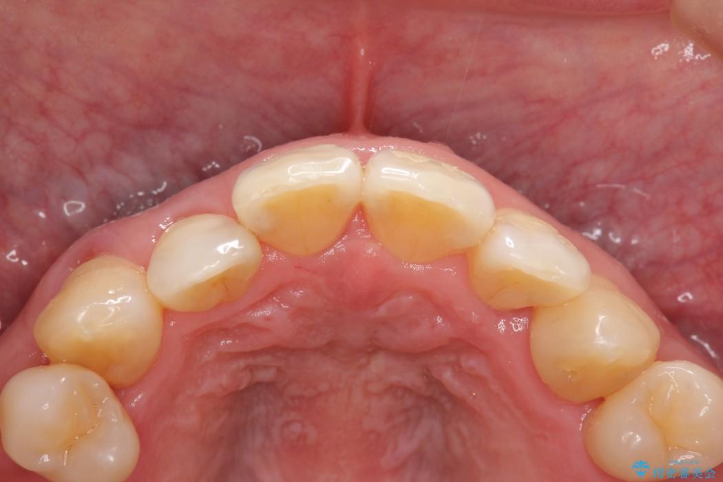 エムドゲインを用いた中等度歯周病治療 治療前画像