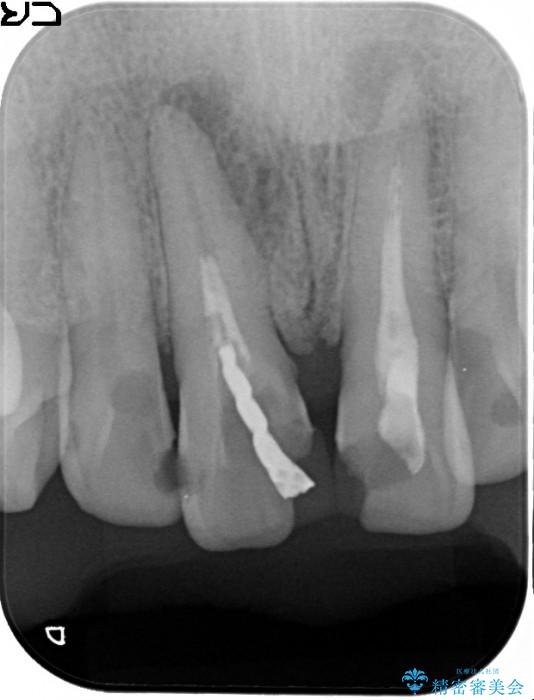 感染根管治療を伴った前歯のセラミック治療 治療前画像