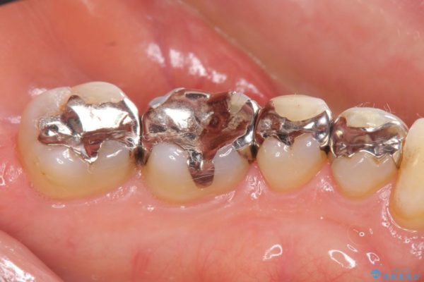 銀歯を白くするセラミックインレー 治療前画像