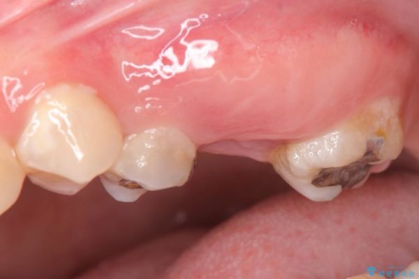 奥歯の親知らず移植 治療前画像
