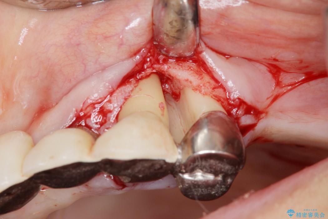 重度歯周病治療(歯槽骨の再生治療) 治療前画像