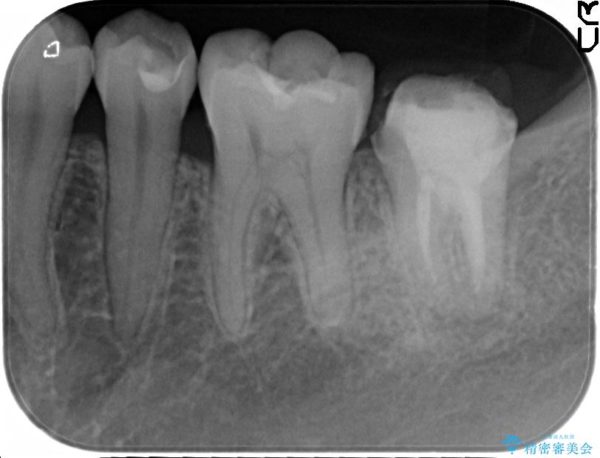 奥歯のストローマン・インプラント 治療前画像