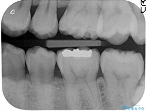 上の奥歯のゴールドインレー 治療前画像