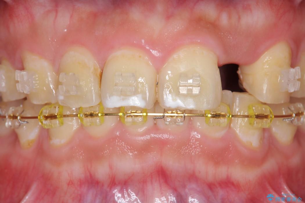 上の前歯のインプラント治療 治療前画像