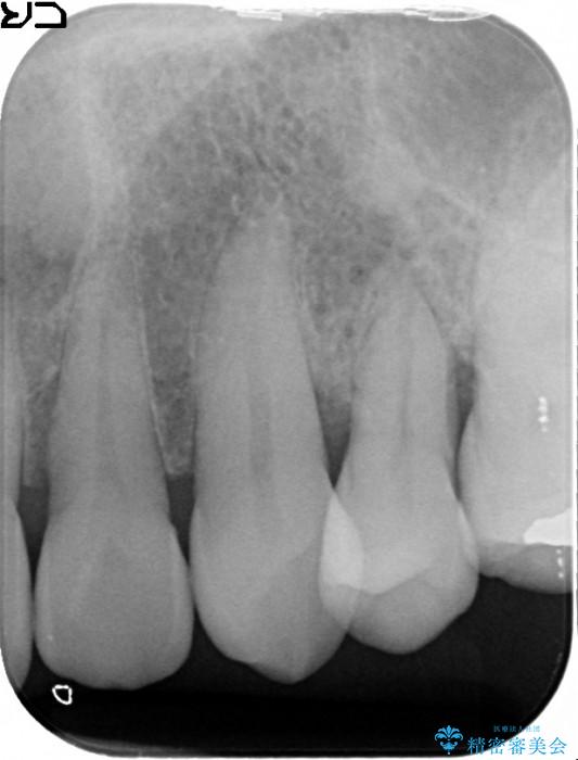 エムドゲインを用いた中等度歯周病治療 治療前画像