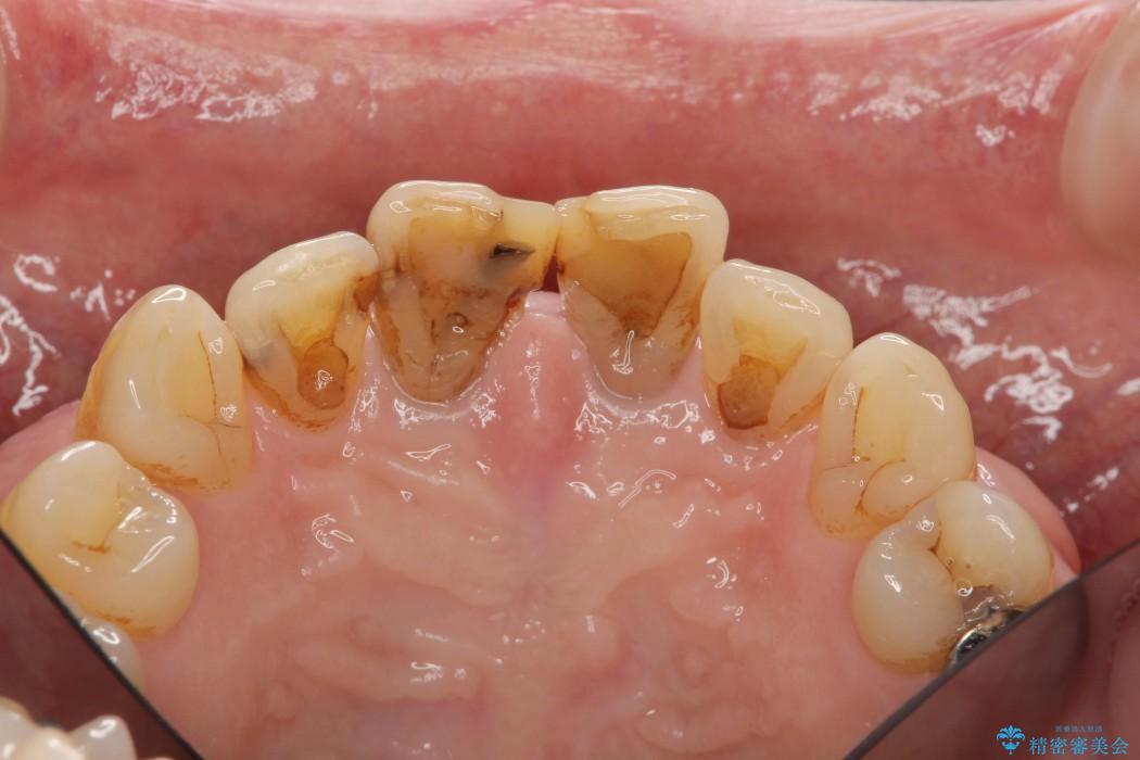感染根管治療を伴った前歯のセラミック治療 治療前画像