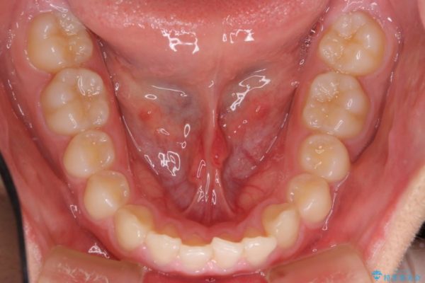 前歯のすき間と過蓋咬合のワイヤー矯正 治療前画像