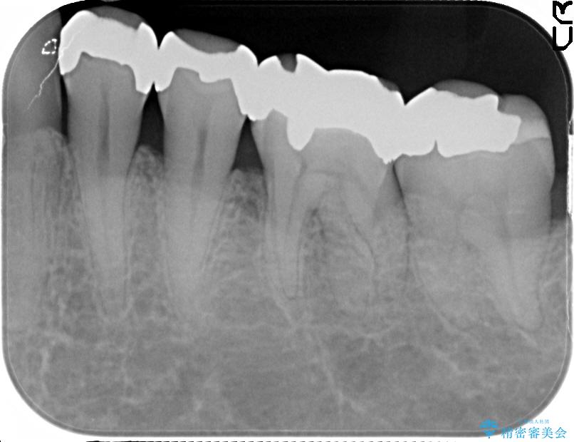 銀歯を白くするセラミックインレー 治療前画像