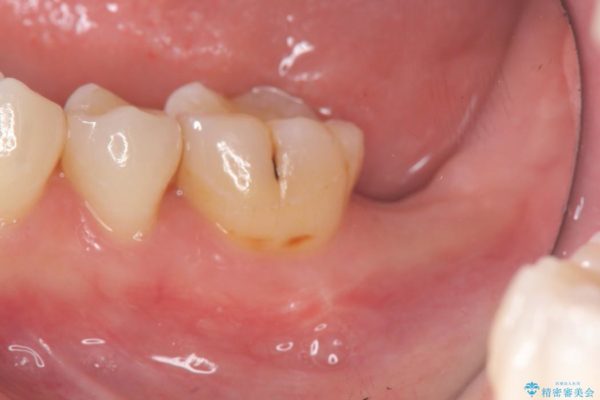奥歯のストローマン・インプラント 治療前画像