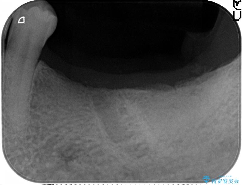 奥歯で噛みたいインプラント治療 治療前画像