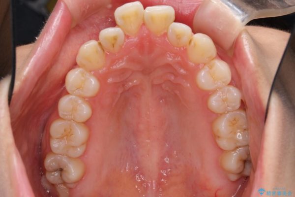 出っ歯(オーバージェット10mm)のワイヤー矯正 治療前画像
