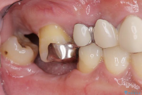 インプラントを用いた重度歯周病治療 治療前画像