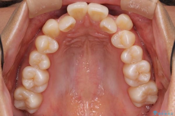 根の短い歯を抜歯 がたがたの歯並び矯正 治療前画像