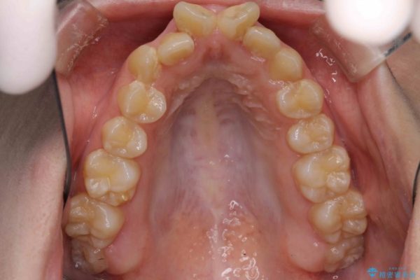 前歯のねじれと出っ歯の矯正 治療前画像