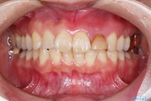 グラグラする前歯のブリッジ治療 治療前画像