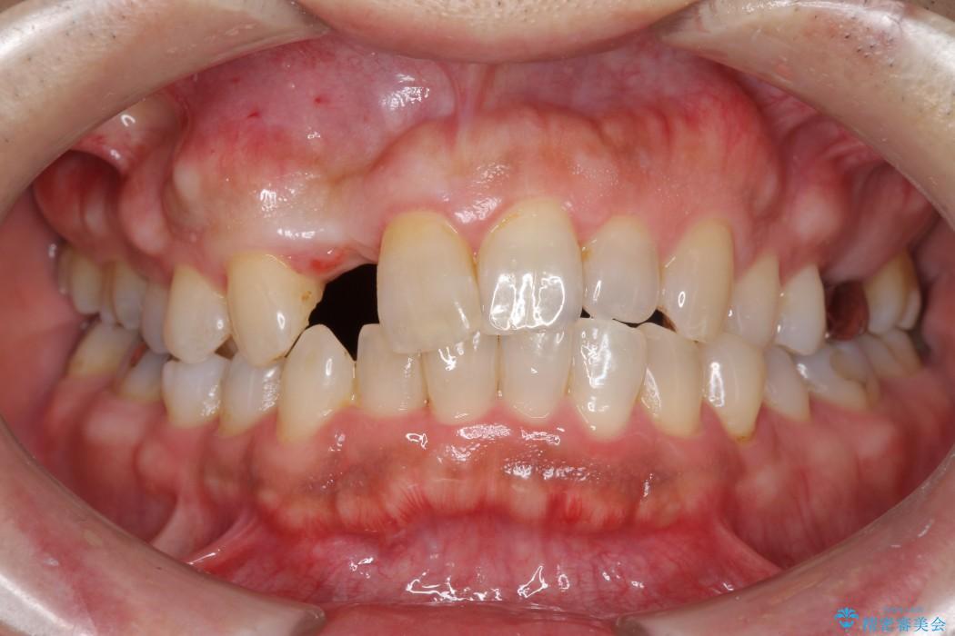 前歯のインプラント治療(インプラント埋入まで) 治療前画像