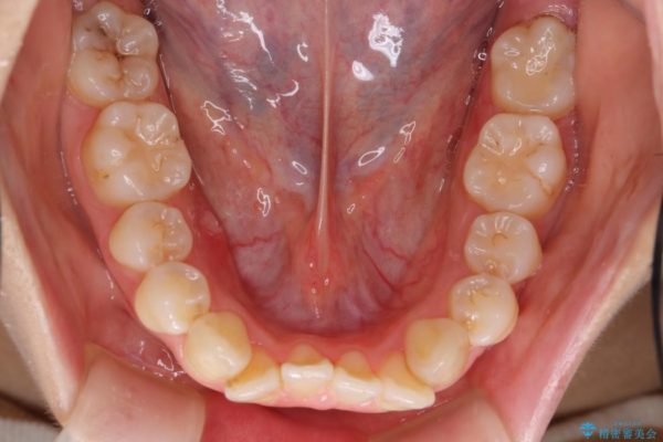 出っ歯(オーバージェット10mm)のワイヤー矯正 治療前画像