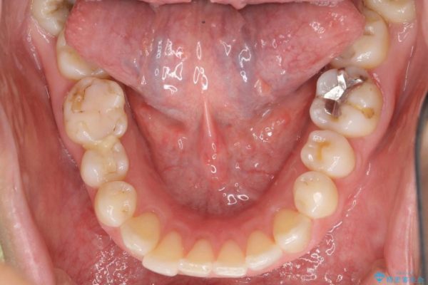 30代女性 出っ歯の再矯正治療 治療前画像