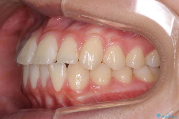 インビザラインで再矯正治療と右上前歯のセラミック治療 治療前画像